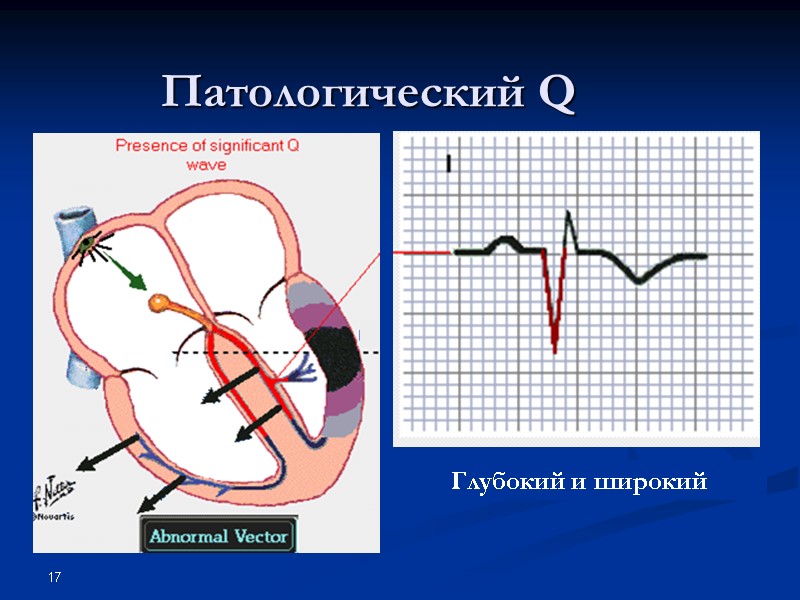 17 Патологический Q Глубокий и широкий